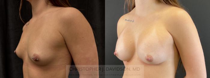 Breast Augmentation Case 482 Before & After Left Oblique | Boston, MA | Christopher J. Davidson, MD