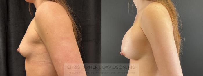 Breast Augmentation Case 482 Before & After Left Side | Boston, MA | Christopher J. Davidson, MD