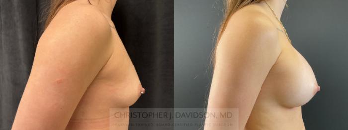 Breast Augmentation Case 482 Before & After Right Side | Boston, MA | Christopher J. Davidson, MD