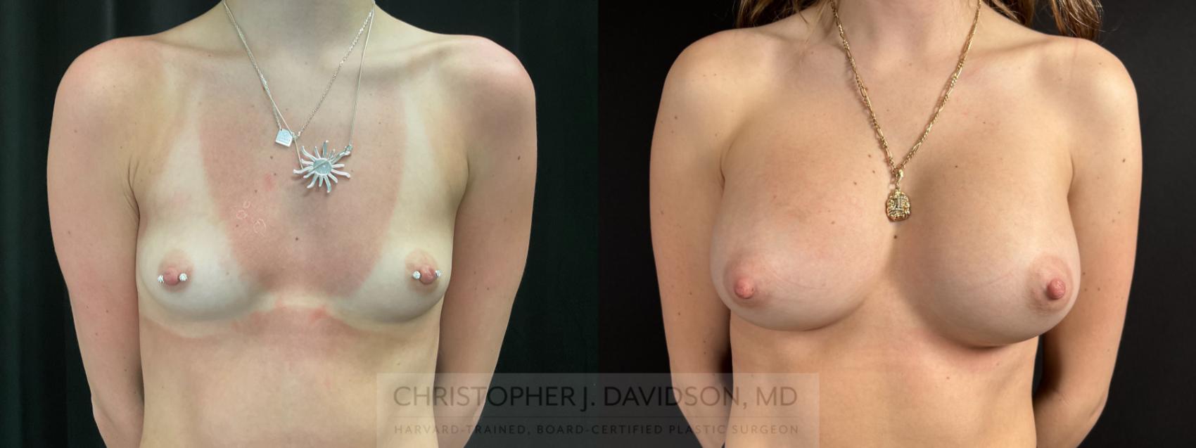 Breast Augmentation Case 485 Before & After Front | Boston, MA | Christopher J. Davidson, MD