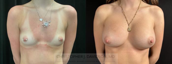Breast Augmentation Case 485 Before & After Front | Boston, MA | Christopher J. Davidson, MD