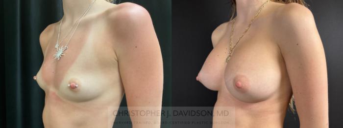 Breast Augmentation Case 485 Before & After Left Oblique | Boston, MA | Christopher J. Davidson, MD