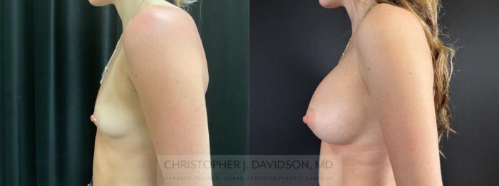 Breast Augmentation Case 485 Before & After Left Side | Boston, MA | Christopher J. Davidson, MD