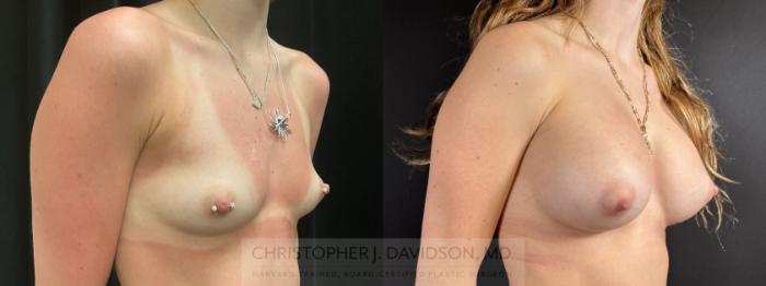 Breast Augmentation Case 485 Before & After Right Oblique | Boston, MA | Christopher J. Davidson, MD