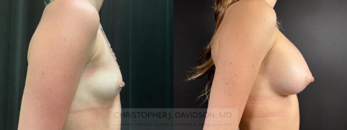 Breast Augmentation Case 485 Before & After Right Side | Boston, MA | Christopher J. Davidson, MD