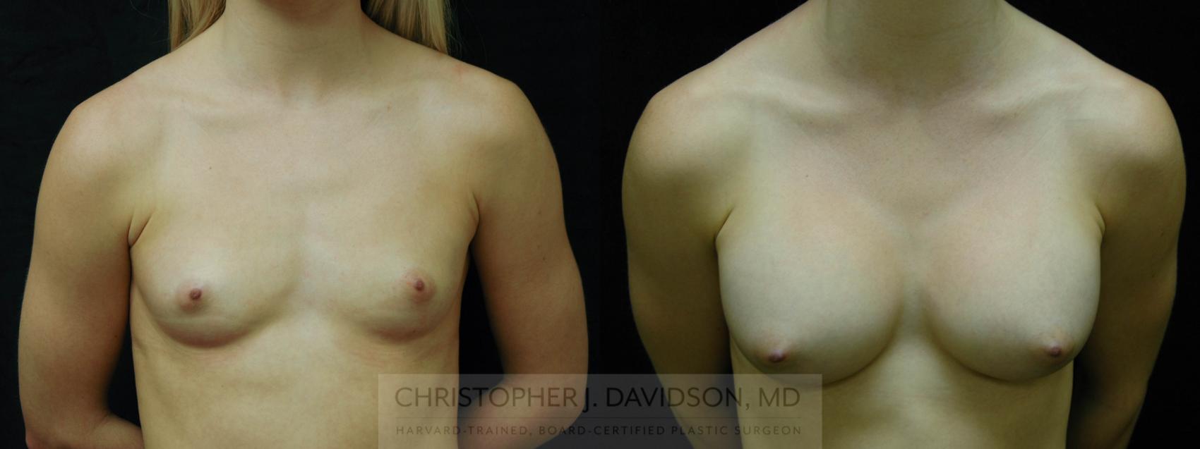 Breast Augmentation Case 49 Before & After View #1 | Wellesley, MA | Christopher J. Davidson, MD