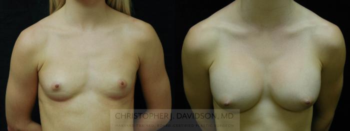 Breast Augmentation Case 49 Before & After View #1 | Boston, MA | Christopher J. Davidson, MD