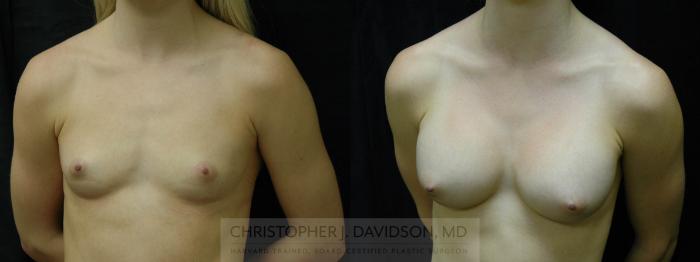 Breast Augmentation Case 49 Before & After View #2 | Boston, MA | Christopher J. Davidson, MD