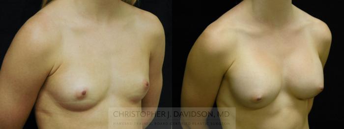 Breast Augmentation Case 49 Before & After View #3 | Boston, MA | Christopher J. Davidson, MD