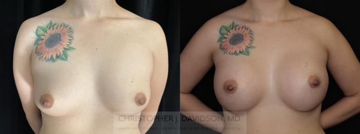 Breast Augmentation Case 493 Before & After Front | Boston, MA | Christopher J. Davidson, MD