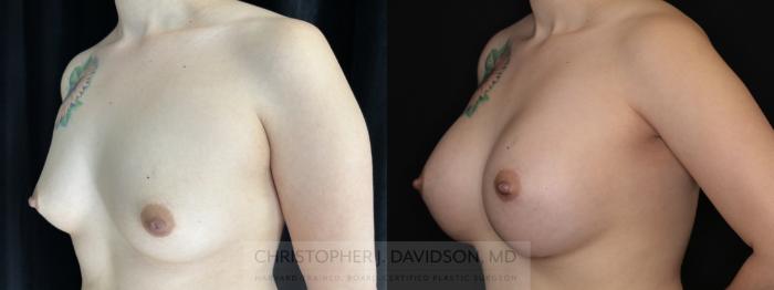 Breast Augmentation Case 493 Before & After Left Oblique | Boston, MA | Christopher J. Davidson, MD