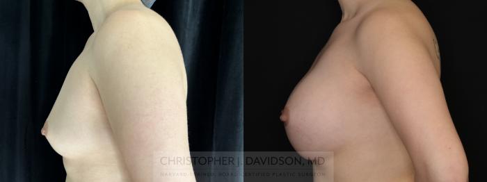 Breast Augmentation Case 493 Before & After Left Side | Boston, MA | Christopher J. Davidson, MD