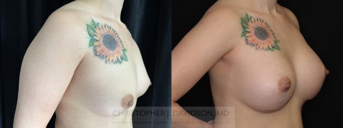 Breast Augmentation Case 493 Before & After Right Oblique | Boston, MA | Christopher J. Davidson, MD