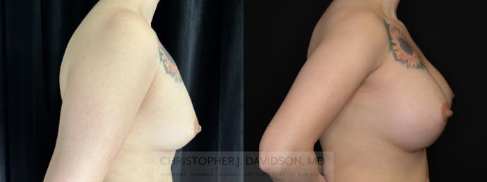 Breast Augmentation Case 493 Before & After Right Side | Boston, MA | Christopher J. Davidson, MD