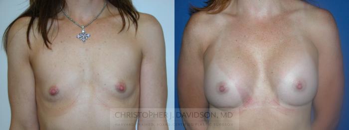 Breast Augmentation Case 51 Before & After View #1 | Boston, MA | Christopher J. Davidson, MD