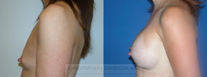 Breast Augmentation Case 51 Before & After View #2 | Boston, MA | Christopher J. Davidson, MD