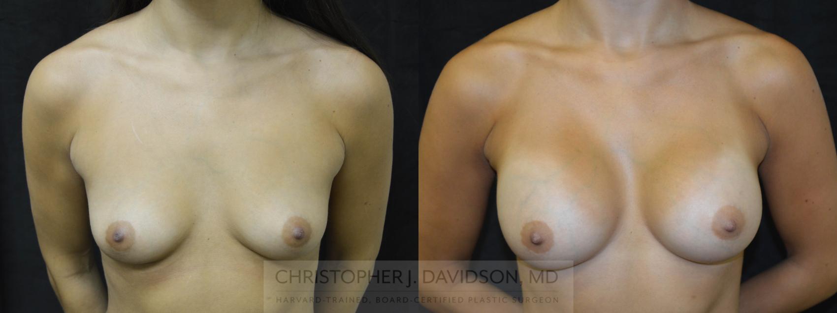 Breast Augmentation Case 54 Before & After View #1 | Boston, MA | Christopher J. Davidson, MD