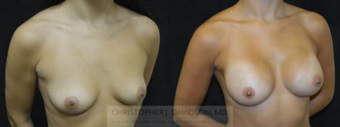 Breast Augmentation Case 54 Before & After View #3 | Boston, MA | Christopher J. Davidson, MD