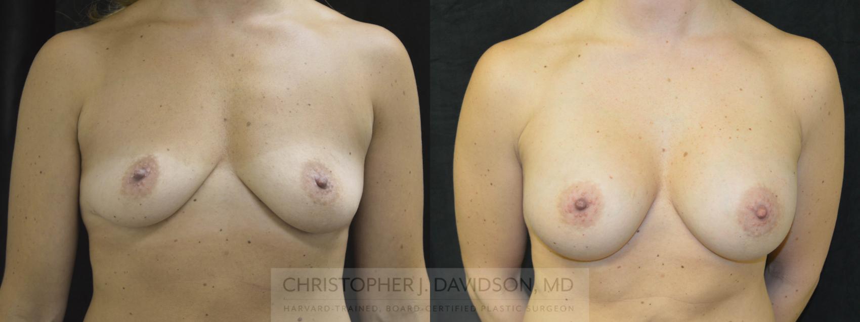 Breast Augmentation Case 57 Before & After View #1 | Boston, MA | Christopher J. Davidson, MD