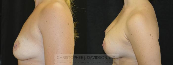 Breast Augmentation Case 57 Before & After View #2 | Boston, MA | Christopher J. Davidson, MD
