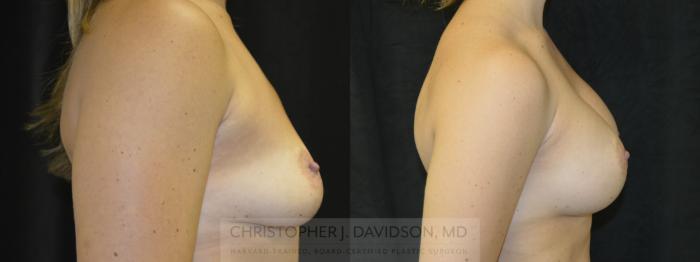 Breast Augmentation Case 57 Before & After View #3 | Boston, MA | Christopher J. Davidson, MD