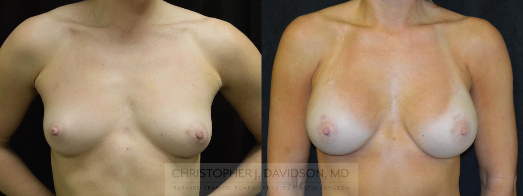 Breast Augmentation Case 62 Before & After View #1 | Boston, MA | Christopher J. Davidson, MD