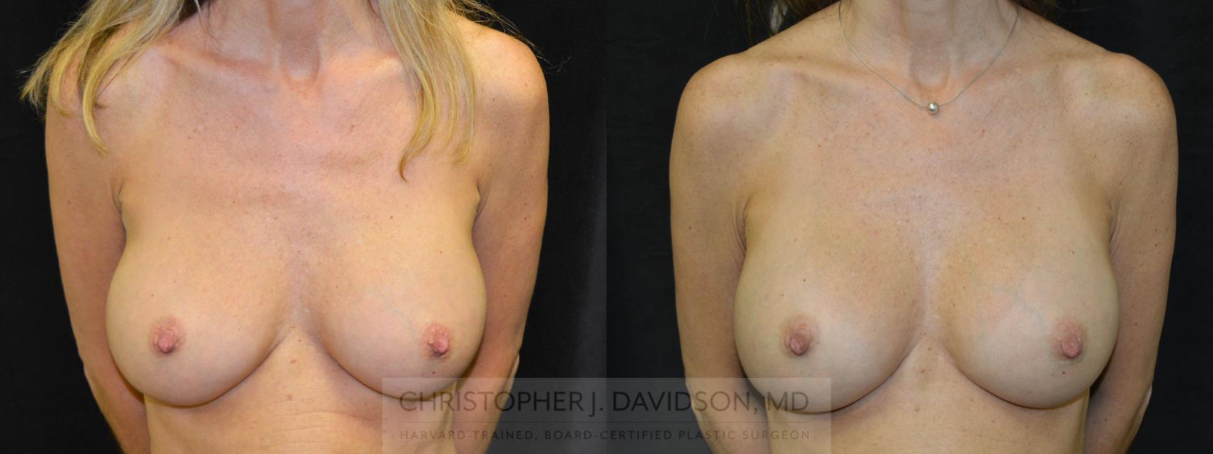 Breast Augmentation Case 66 Before & After View #1 | Boston, MA | Christopher J. Davidson, MD