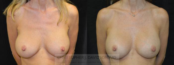 Breast Augmentation Case 66 Before & After View #1 | Boston, MA | Christopher J. Davidson, MD