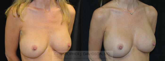 Breast Augmentation Case 66 Before & After View #2 | Boston, MA | Christopher J. Davidson, MD