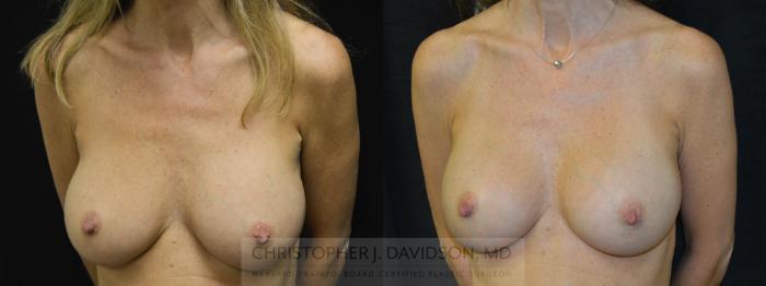 Breast Augmentation Case 66 Before & After View #3 | Boston, MA | Christopher J. Davidson, MD