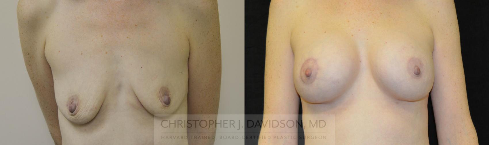 Breast Augmentation Case 69 Before & After View #1 | Wellesley, MA | Christopher J. Davidson, MD