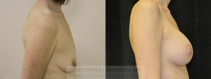 Breast Augmentation Case 69 Before & After View #2 | Boston, MA | Christopher J. Davidson, MD