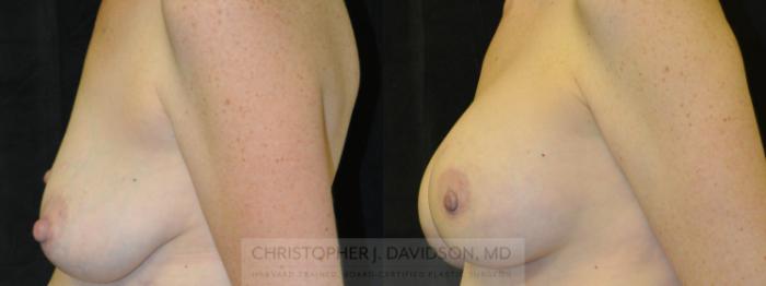 Breast Augmentation Case 69 Before & After View #3 | Boston, MA | Christopher J. Davidson, MD