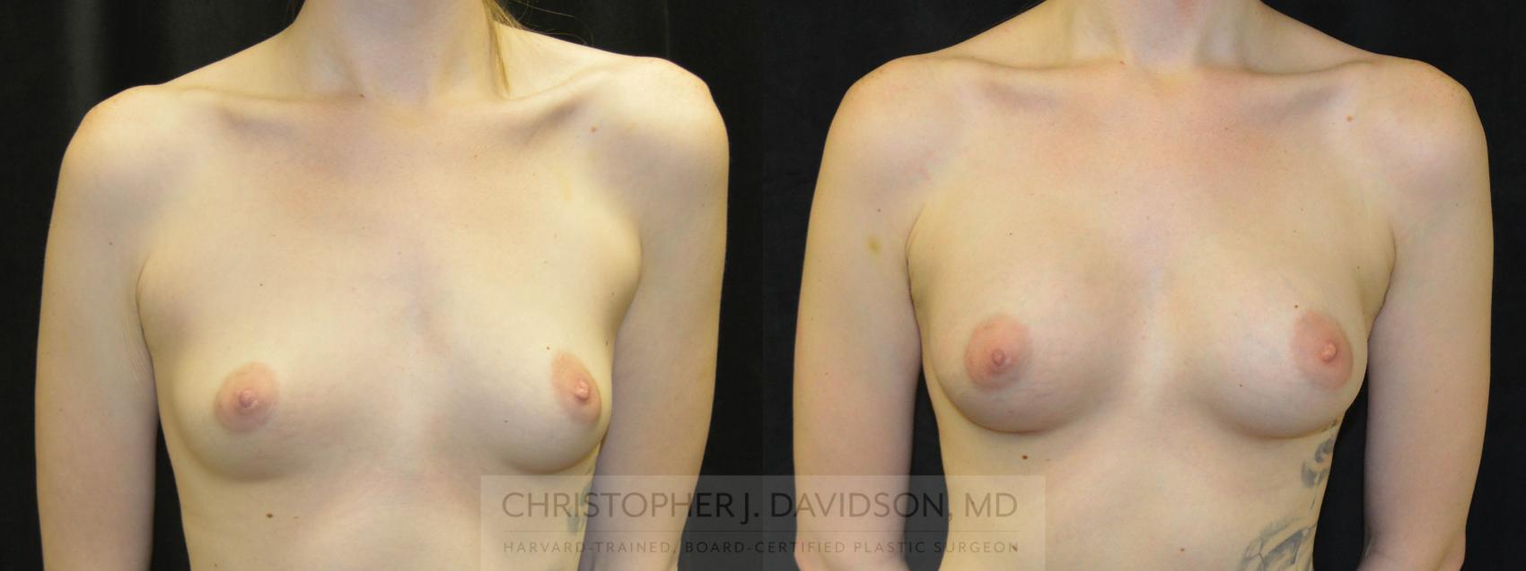 Breast Augmentation Case 81 Before & After View #1 | Boston, MA | Christopher J. Davidson, MD