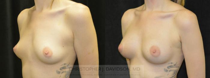 Breast Augmentation Case 81 Before & After View #2 | Boston, MA | Christopher J. Davidson, MD