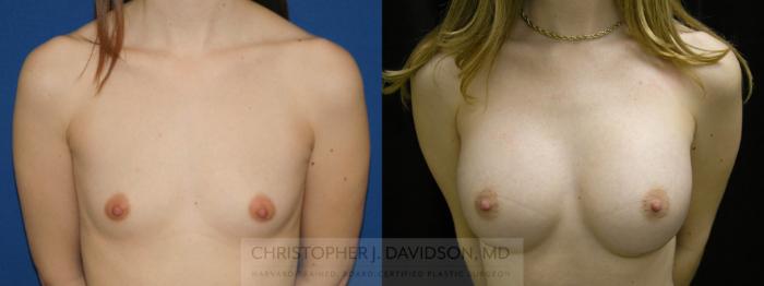 Breast Augmentation Case 96 Before & After View #1 | Boston, MA | Christopher J. Davidson, MD