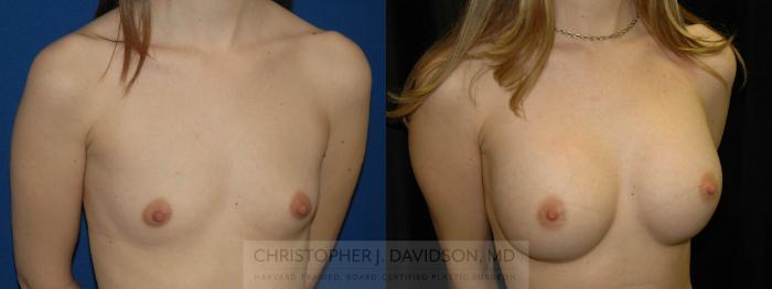 Breast Augmentation Case 96 Before & After View #2 | Boston, MA | Christopher J. Davidson, MD