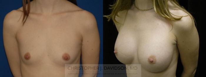 Breast Augmentation Case 96 Before & After View #3 | Boston, MA | Christopher J. Davidson, MD