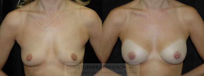 Breast Augmentation Case 98 Before & After View #1 | Boston, MA | Christopher J. Davidson, MD