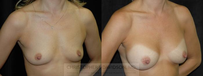 Breast Augmentation Case 98 Before & After View #2 | Boston, MA | Christopher J. Davidson, MD