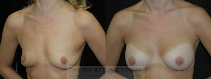 Breast Augmentation Case 98 Before & After View #3 | Boston, MA | Christopher J. Davidson, MD