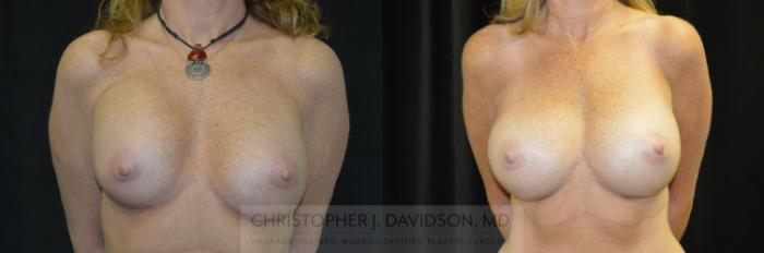 Breast Augmentation Revision Case 234 Before & After View #1 | Boston, MA | Christopher J. Davidson, MD