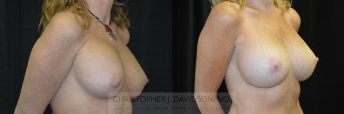 Breast Augmentation Revision Case 234 Before & After View #2 | Boston, MA | Christopher J. Davidson, MD