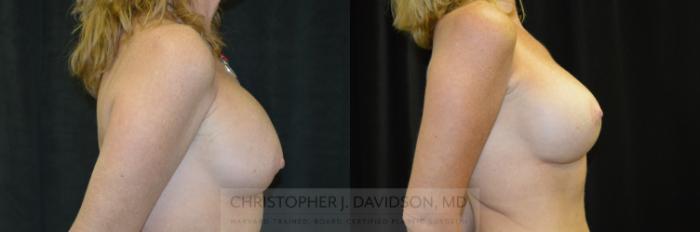 Breast Augmentation Revision Case 234 Before & After View #3 | Boston, MA | Christopher J. Davidson, MD