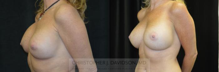 Breast Augmentation Revision Case 234 Before & After View #4 | Boston, MA | Christopher J. Davidson, MD