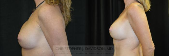 Breast Augmentation Revision Case 234 Before & After View #5 | Boston, MA | Christopher J. Davidson, MD