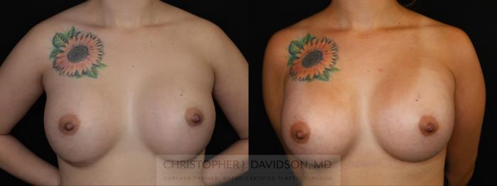 Breast Augmentation Revision Case 492 Before & After Front | Boston, MA | Christopher J. Davidson, MD