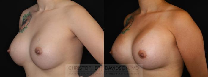 Breast Augmentation Revision Case 492 Before & After Left Oblique | Boston, MA | Christopher J. Davidson, MD