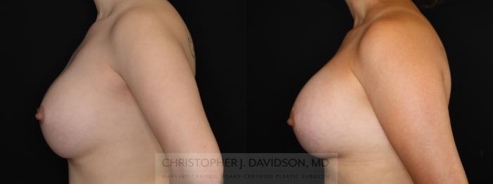 Breast Augmentation Revision Case 492 Before & After Left Side | Boston, MA | Christopher J. Davidson, MD