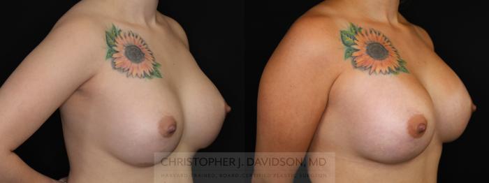 Breast Augmentation Revision Case 492 Before & After Right Oblique | Boston, MA | Christopher J. Davidson, MD